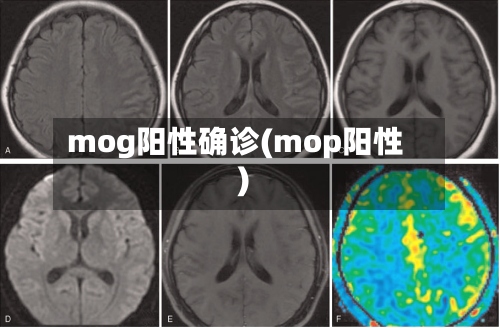 mog阳性确诊(mop阳性)