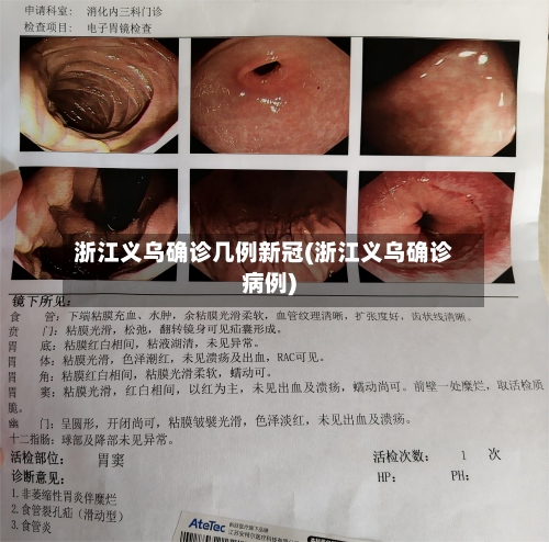 浙江义乌确诊几例新冠(浙江义乌确诊病例)-第2张图片
