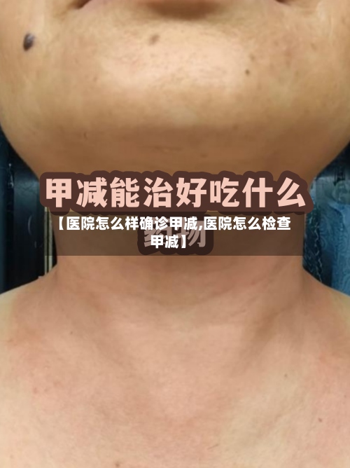 【医院怎么样确诊甲减,医院怎么检查甲减】-第3张图片