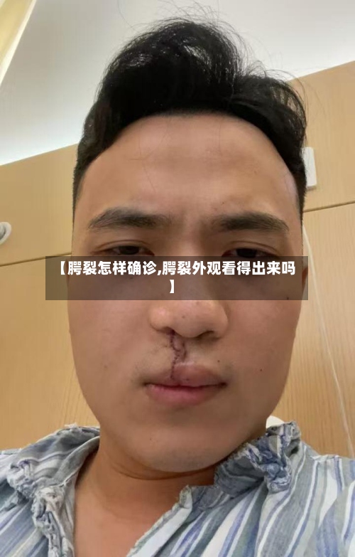 【腭裂怎样确诊,腭裂外观看得出来吗】-第2张图片