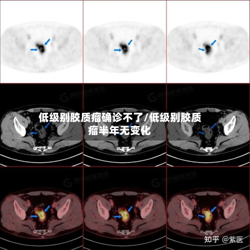 低级别胶质瘤确诊不了/低级别胶质瘤半年无变化