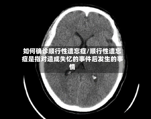 如何确诊顺行性遗忘症/顺行性遗忘症是指对造成失忆的事件后发生的事情-第3张图片