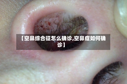 【空鼻综合征怎么确诊,空鼻症如何确诊】-第3张图片