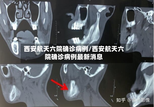 西安航天六院确诊病例/西安航天六院确诊病例最新消息-第2张图片