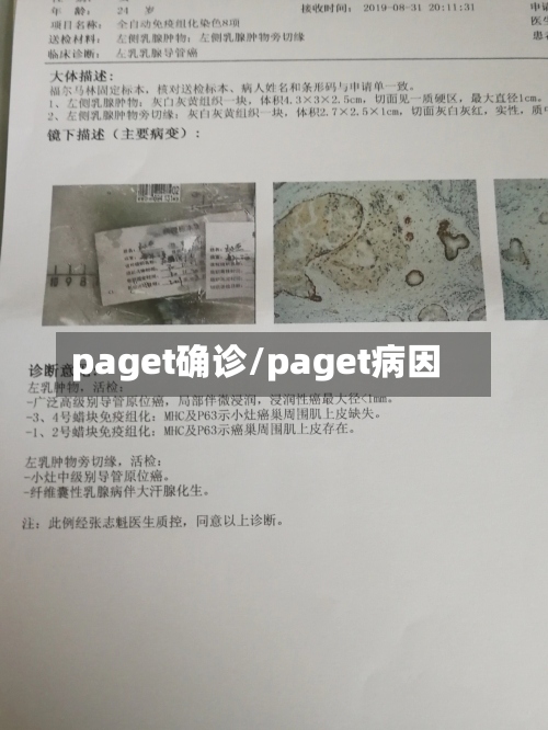 paget确诊/paget病因-第2张图片