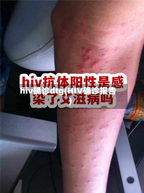 hiv确诊dtg(HIV确诊报告)