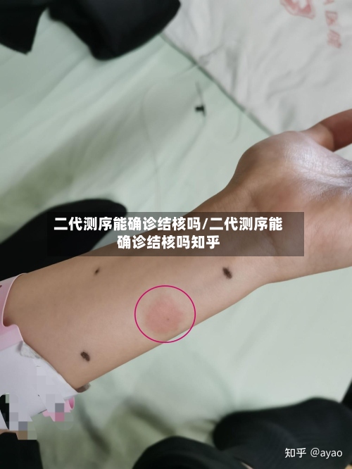 二代测序能确诊结核吗/二代测序能确诊结核吗知乎