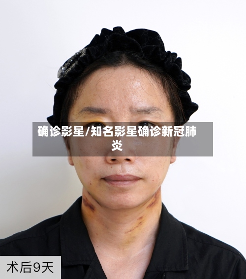 确诊影星/知名影星确诊新冠肺炎-第2张图片