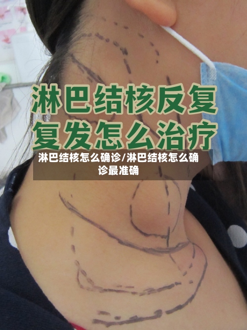 淋巴结核怎么确诊/淋巴结核怎么确诊最准确
