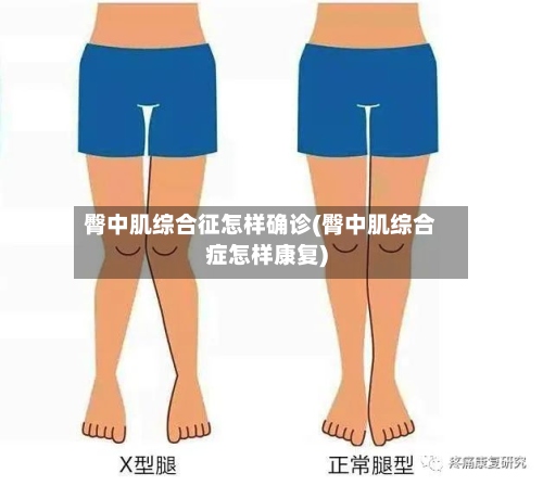 臀中肌综合征怎样确诊(臀中肌综合症怎样康复)