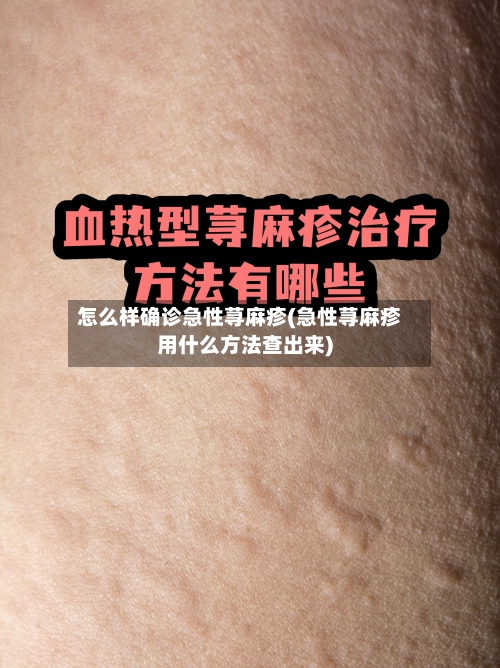 怎么样确诊急性荨麻疹(急性荨麻疹用什么方法查出来)