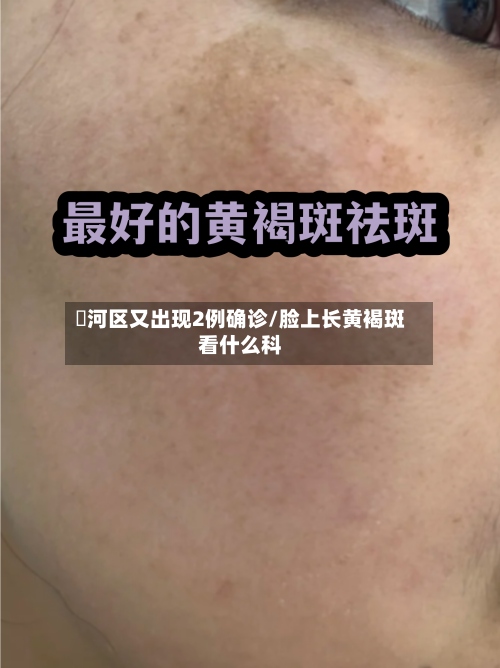 瀍河区又出现2例确诊/脸上长黄褐斑看什么科-第2张图片