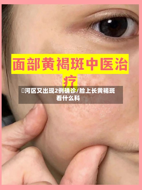 瀍河区又出现2例确诊/脸上长黄褐斑看什么科