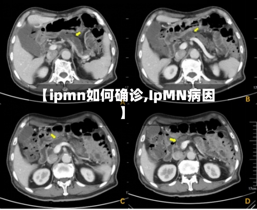 【ipmn如何确诊,IpMN病因】