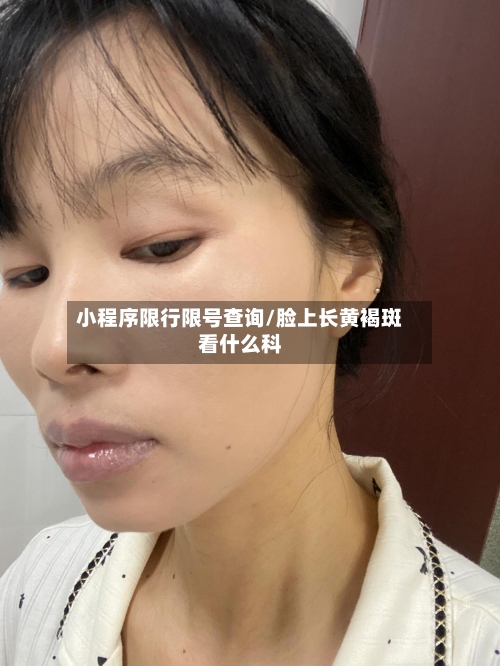 小程序限行限号查询/脸上长黄褐斑看什么科
